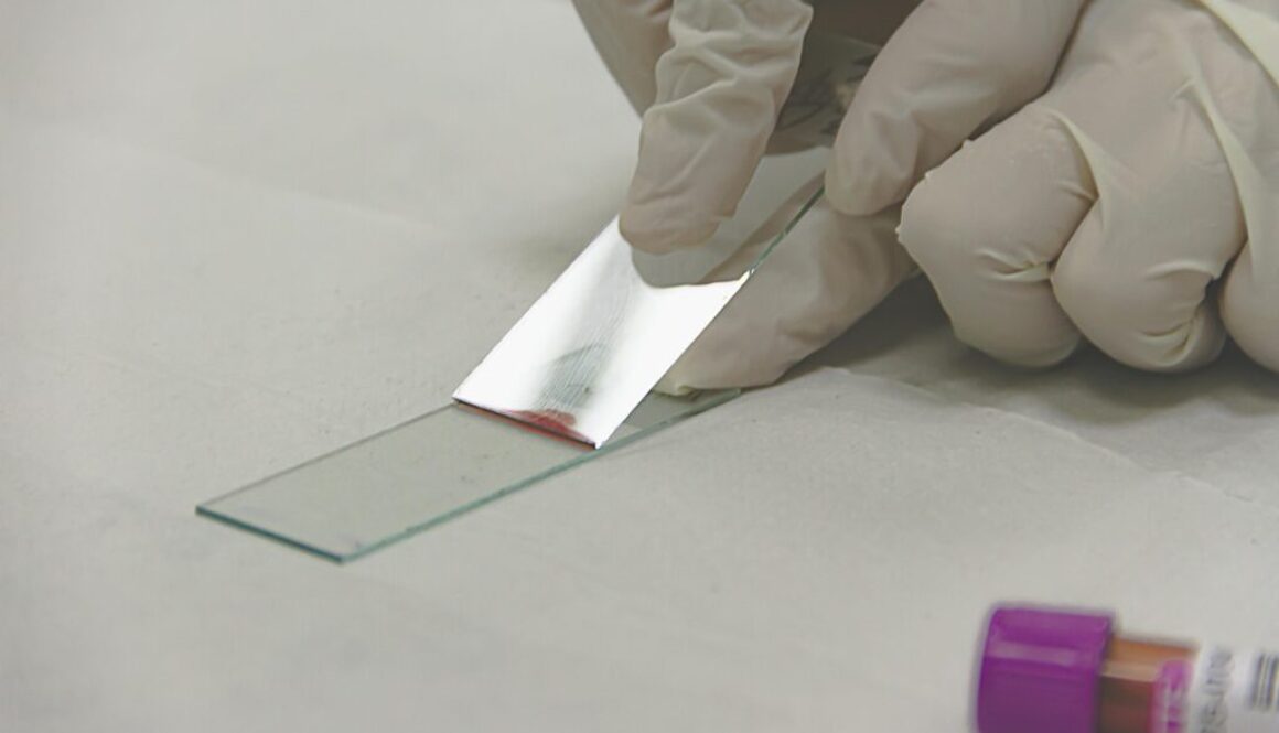 Blood test sample for colon cancer screening, showing a vial of blood being prepared for analysis to detect colorectal cancer biomarkers.