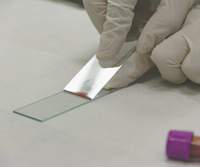 Blood test sample for colon cancer screening, showing a vial of blood being prepared for analysis to detect colorectal cancer biomarkers.